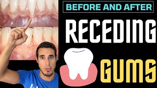 RECEDING GUMS  Before and after [upl. by Nwahsit]