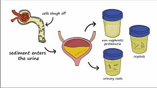 Analgesic Nephropathy AN Kidney Damage from NSAIDs [upl. by Loni144]