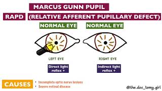 Abnormal Pupillary Reflexes  Ophthalmology [upl. by Garges8]