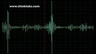 Mitral Stenosis rheumatic [upl. by Anik529]