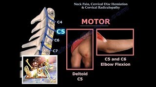 Neck Pain Cervical Disc Herniation amp RadiculopathyEverything You Need To Know  Dr Nabil Ebraheim [upl. by Blaire]