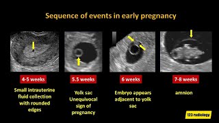 IVF Explained How the egg retrieval process works [upl. by Amandi714]