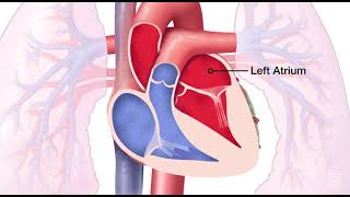 Mitral Valve Regurgitation [upl. by Egan]