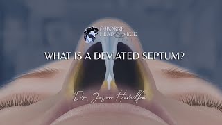 What is a deviated septum [upl. by Nive]