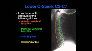 Radiology of Spine Trauma [upl. by Kynthia]