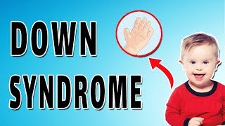 Down Syndrome Features [upl. by Rafat406]