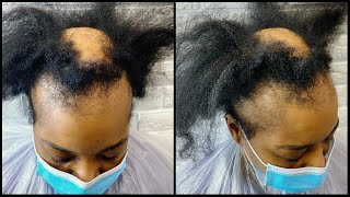 Female Hair Loss  The different type of womens hair loss [upl. by Eliason124]