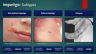 Impetigo Subtypes [upl. by Utta]