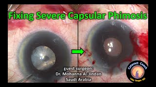 Severe Capsular Phimosis [upl. by Averill834]