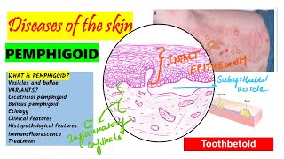 Pemphigoid Causes pathogenesis Types Histopathology Treatment  Pemphigus vs Pemphigoid [upl. by Conrade]