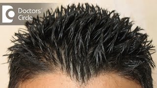 Alopecia Hair Makeover  How To Cover Bald Spots For Women  Alopecia Hair Transformation [upl. by Rhoda]