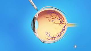 Retina Road to Recovery after Vitrectomy Surgery weeks 9 and 10 [upl. by Keel473]