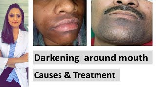 Darkening around mouth  causes  treatment  Dermatologist  Dr Aanchal Panth [upl. by Allen]