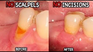 Gum Recession Causes amp Treatment The Pinhole Technique [upl. by Reifnnej]