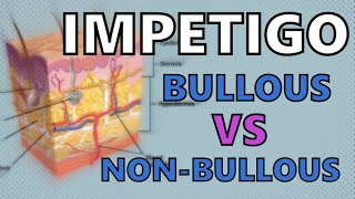 IMPETIGO EXPLAINED IN 2 MINUTES  BULLOUS vs NONBULLOUS IMPETIGO [upl. by Nylirrehs]