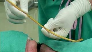 BougieAided Cricothyrotomy by Darren Braude [upl. by Icart115]