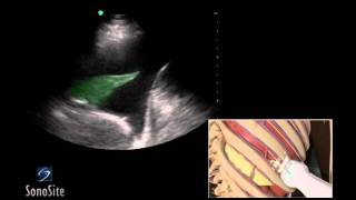 How To Ultrasound Guided Thoracentesis Exam 3D Video [upl. by Llenroc]