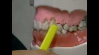 What Causes Gum Recession and How To Treat It [upl. by Jasun]