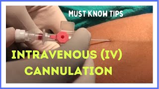 INTRAVENOUS IV CANNULATION in 5 mins How to insert [upl. by Karna]