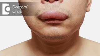 LIP FILLERS  First time tips for faster healing [upl. by Lorilyn]