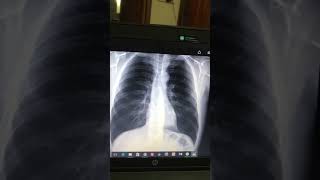 Pleural Effusion Final prof Xray interpretation [upl. by Frayda428]