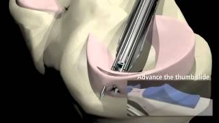 Arthroscopic Meniscus Repair [upl. by Zebe]