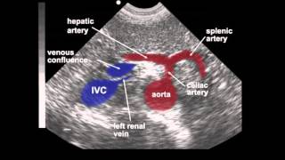 Abdominal Aortic Aneurysm AAA Ultrasound [upl. by Wesa]